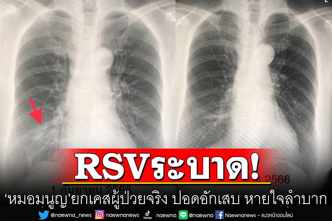 RSV ระบาด! 'หมอมนูญ'ยกเคสผู้ป่วยจริง ปอดอักเสบ อาจอาการหนัก หายใจลำบาก