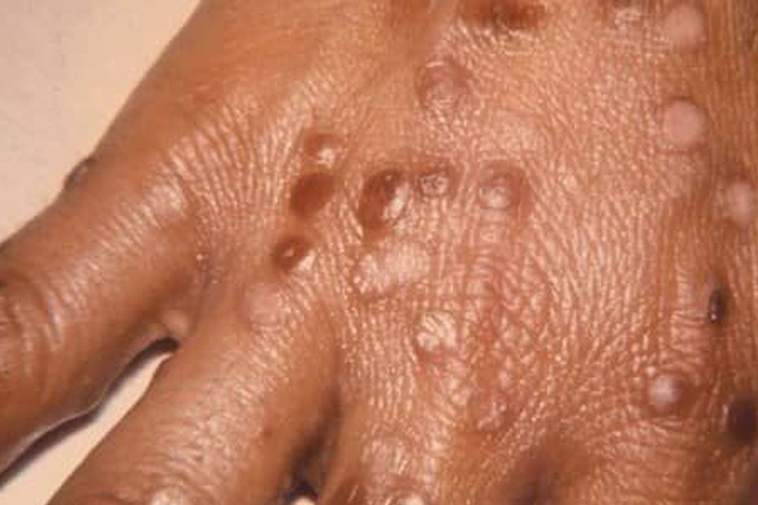 Surge in Smallpox Cases: 42 People Infected in 7 Days