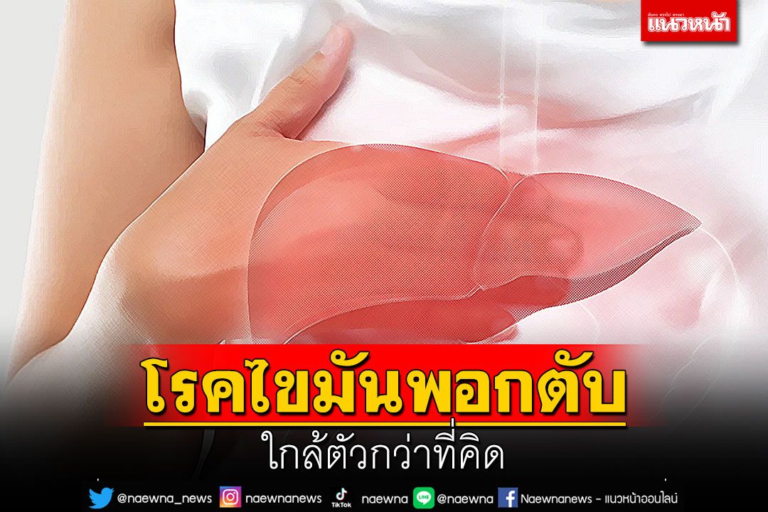 โรคไขมันพอกตับ ใกล้ตัวกว่าที่คิด