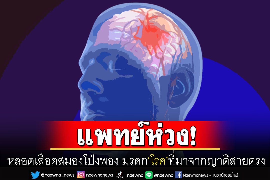 แพทย์ห่วง! 'โรคหลอดเลือดสมองโป่งพอง'อันตรายถึงชีวิต มรดกโรคที่มาจากญาติสายตรง