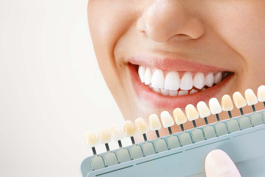ออกแบบรอยยิ้มด้วยการทำวีเนียร์ เพื่อให้คุณมีรอยยิ้มที่เป็นตัวคุณเอง