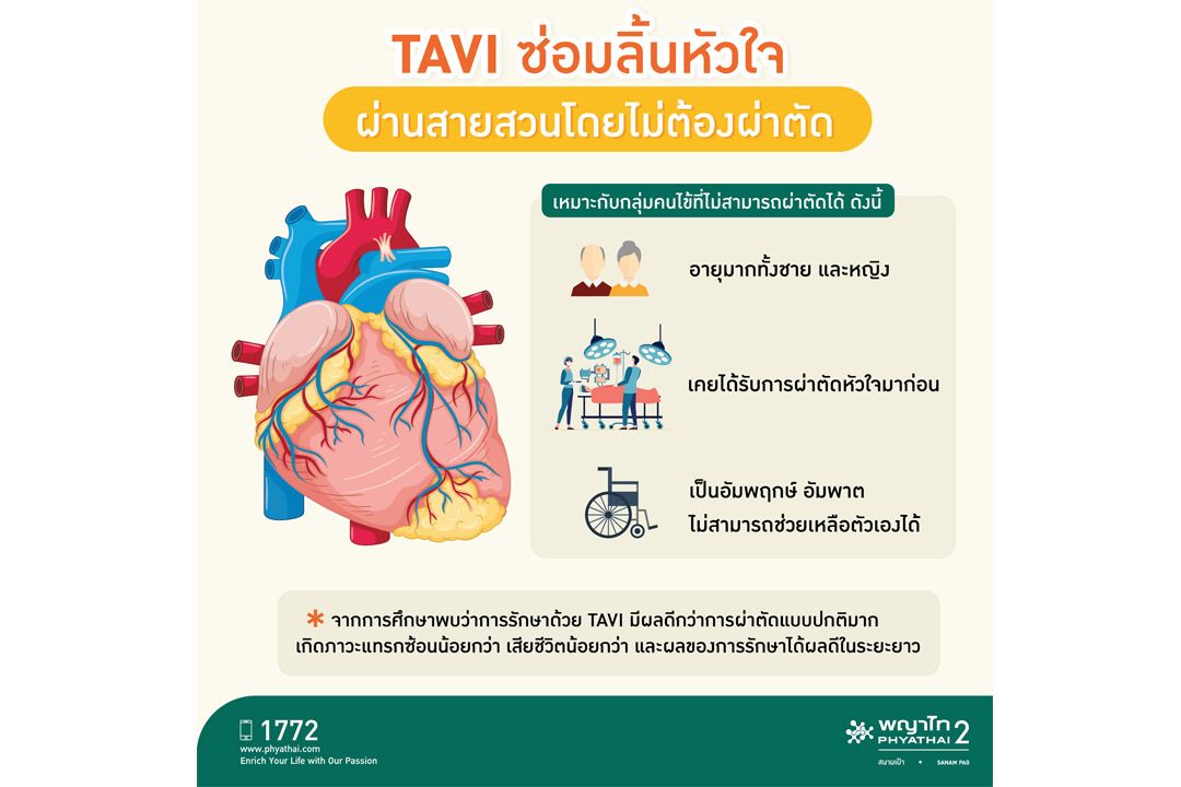 นวัตกรรมเพื่อผู้สูงอายุและผู้ป่วยโรคหัวใจ ‘TAVI’ ซ่อมลิ้นหัวใจผ่านสายสวนโดยไม่ต้องผ่าตัด