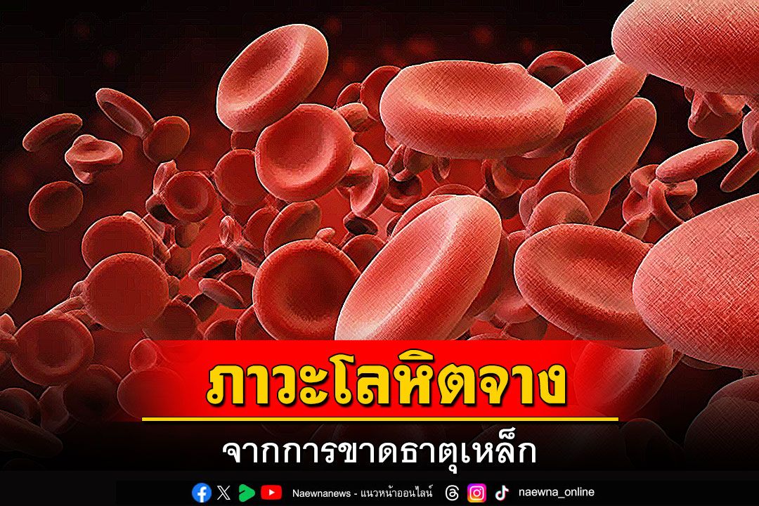ภาวะโลหิตจางจากการขาดธาตุเหล็ก