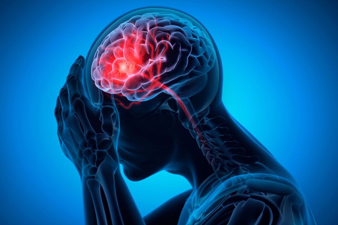 Biplane DSA ทางเลือกใหม่รักษาหลอดเลือดสมองโป่งพอง