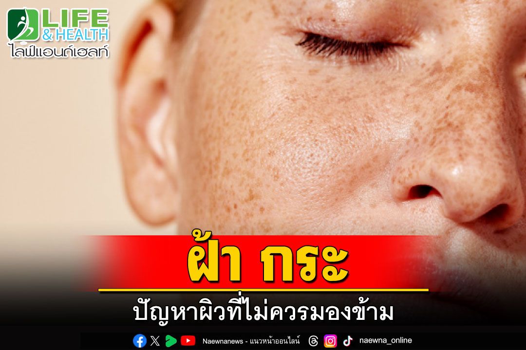 Life & Health : ฝ้า กระ ปัญหาผิวที่ไม่ควรมองข้าม