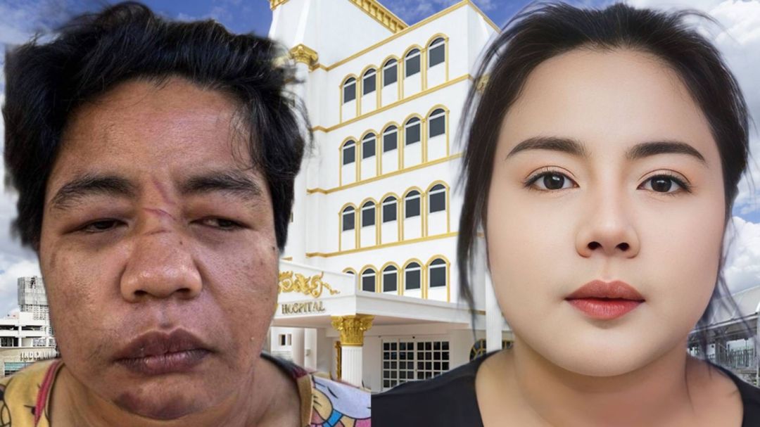 โรงพยาบาลเอเซียโชว์ผลงานระดมทีมแพทย์แก้ไขใบหน้า'น้องเอ'สวยออร่าราวกับเกิดใหม่หลังถูกทารุณเสียโฉม