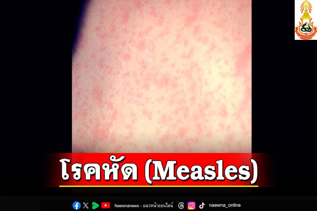 โรคหัด (Measles)