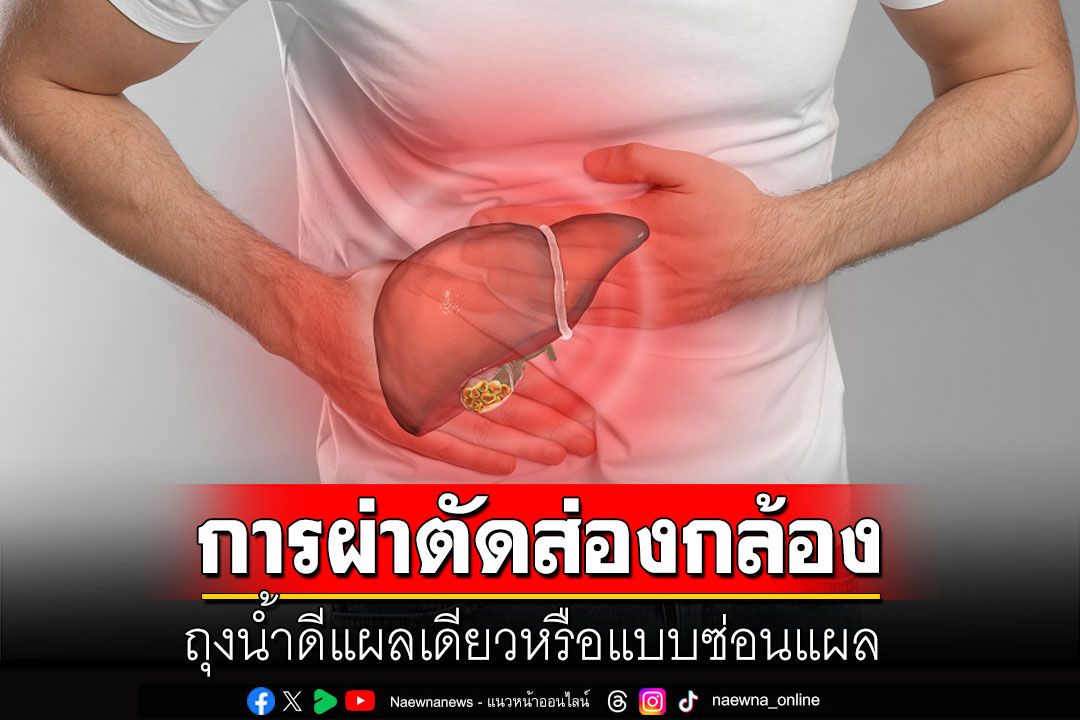 การผ่าตัดส่องกล้องถุงน้ำดีแผลเดียวหรือแบบซ่อนแผล