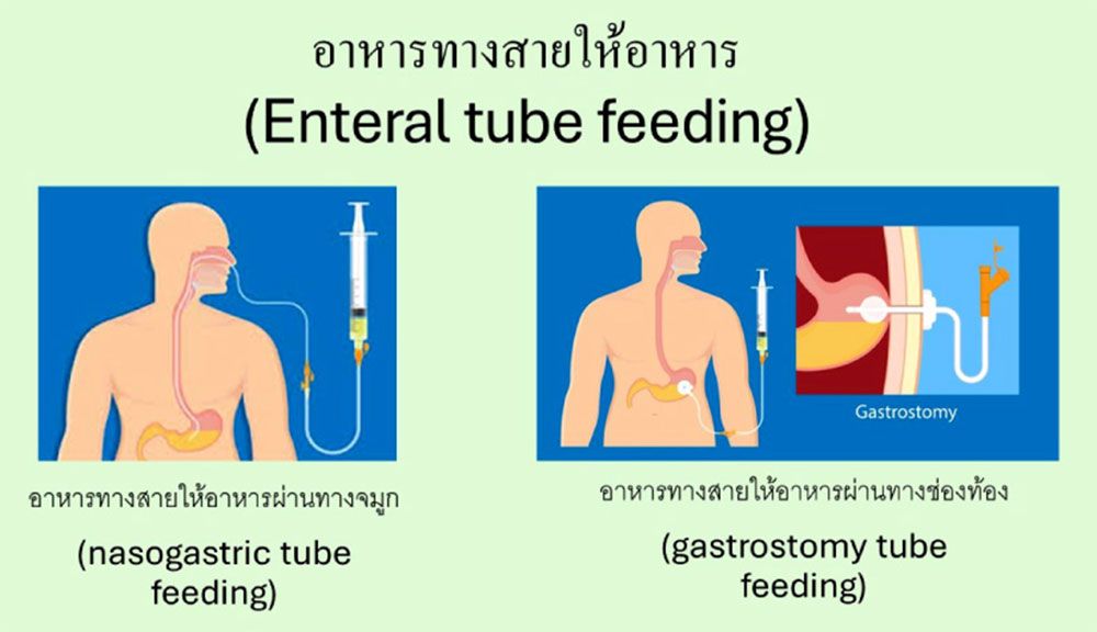 การให้อาหารทางสายให้อาหาร (enteral tube feeding) คืออะไร และผู้ป่วยแบบไหนควรได้รับ