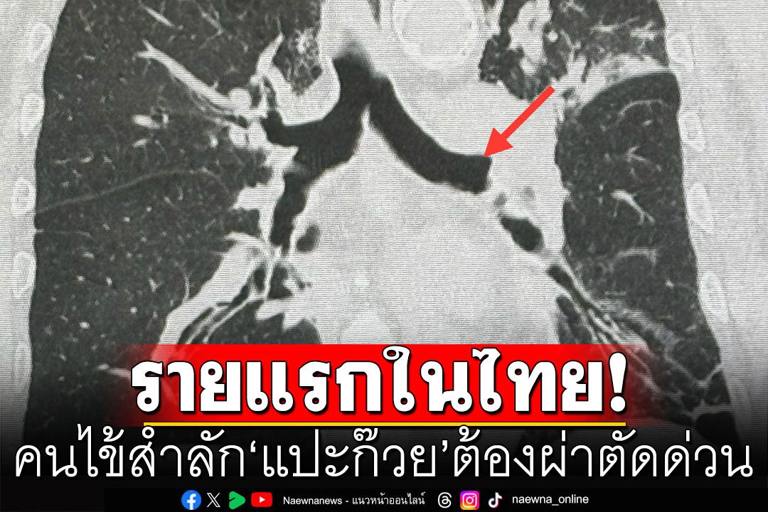เคสแรกในไทย! คนไข้สำลัก‘แปะก๊วย’ ต้องผ่าตัดด่วน ซ้ำทำปอดอักเสบติดเชื้อ