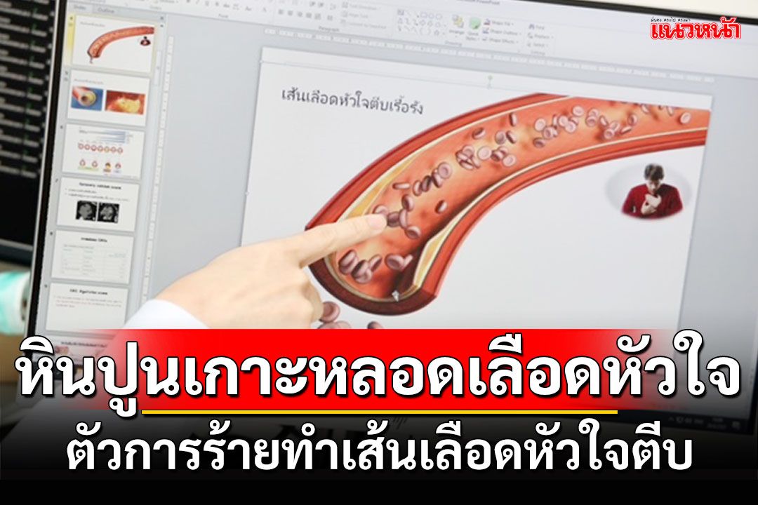‘หินปูนเกาะหลอดเลือดหัวใจ’ ตัวการร้ายทำเส้นเลือดหัวใจตีบ แพทย์เตือนคนไทย ตรวจ ‘Calcium score’ เพื่อหยุดความเสี่ยง