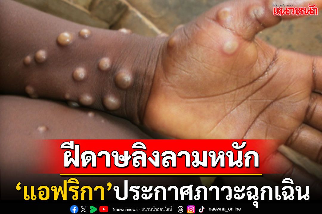 แอฟริกาประกาศภาวะฉุกเฉิน! 'ฝีดาษลิง'ระบาดข้ามชายแดน กระทบแล้วหลายพันชีวิต