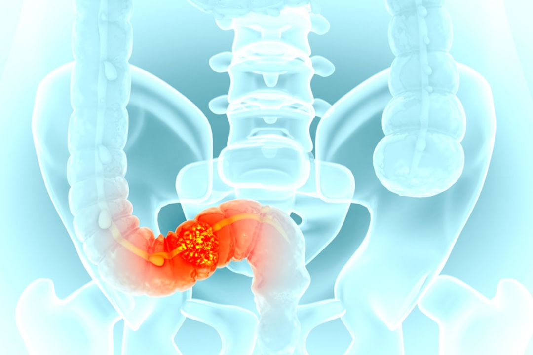 ผ่าตัดมะเร็งลำไส้ใหญ่ ด้วยเทคนิคเก็บทวารหนัก ไม่ต้องพึ่งทวารเทียม