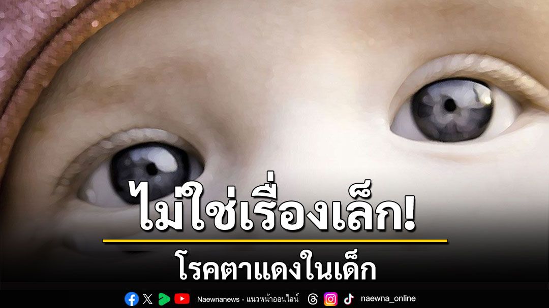 อย่ามองข้าม! โรคตาแดงในเด็กไม่ใช่เรื่องเล็ก ยังไม่มียารักษาเฉพาะ