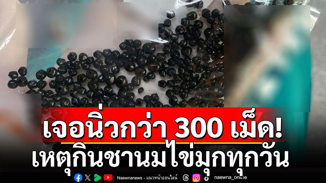 ขนลุก! เจอนิ่วในถุงน้ำดีกว่า 300 เม็ด เหตุกินชานมไข่มุกทุกวัน