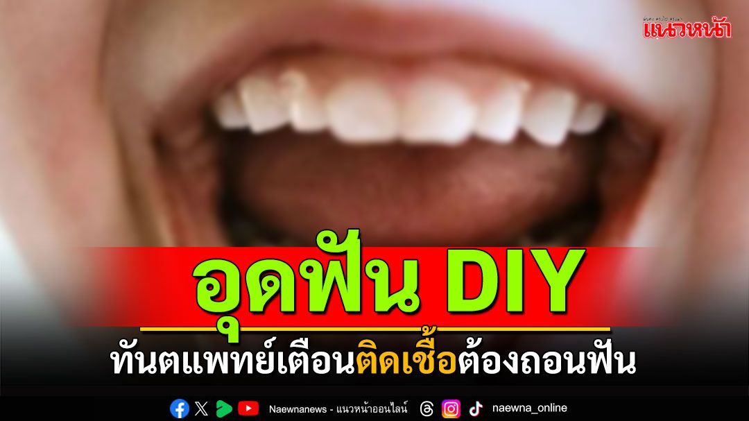 อุดฟัน DIY ทันตแพทย์เตือน เสี่ยงติดเชื้อต้องถอนฟัน