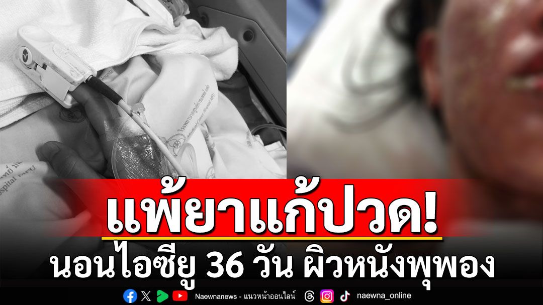 สาวแชร์อุทาหรณ์! แพ้ยาแก้ปวดรุนแรง นอนไอซียู 36 วัน ผิวหนังพุพอง