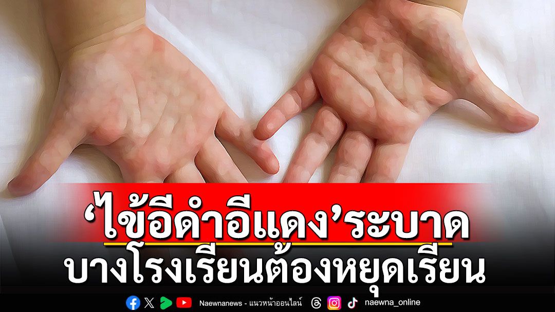 'หมอแล็บ' เตือน'ไข้อีดำอีแดง'ระบาด บางโรงเรียนต้องหยุดเรียน