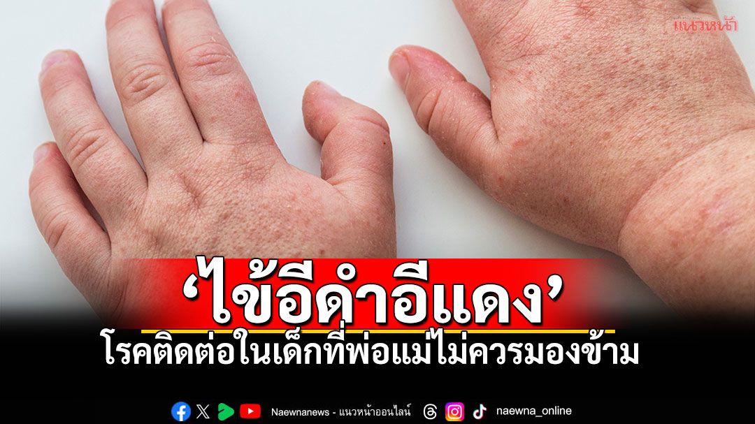 ‘ไข้อีดำอีแดง’ โรคติดต่อในเด็กที่พ่อแม่ไม่ควรมองข้าม