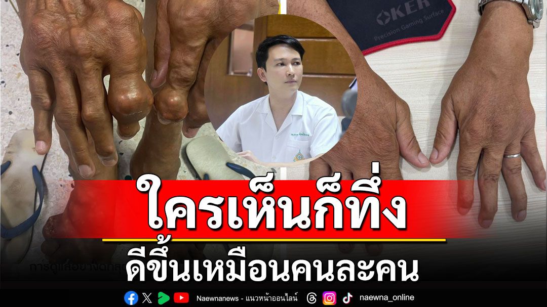 แพทย์ รพ.สุโขทัย รักษาผู้ป่วยโรคเก๊าท์ มือ-เท้าผิดรูป เห็นแล้วทึ่ง