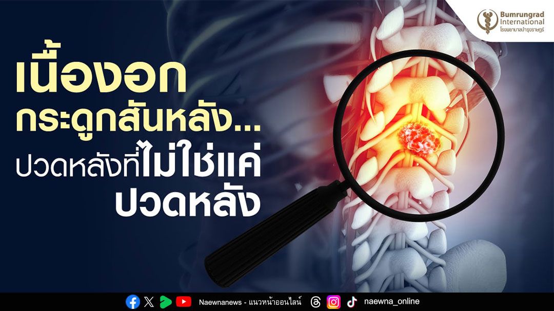 ระวัง !! ปวดหลัง แค่ไม่ใช่ปวดหลัง อาจเสี่ยงเนื้องอกกระดูกสันหลัง