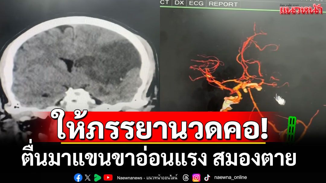 ไม่ใช่ใครก็นวดได้! เปิดเคส ชายแขนขาอ่อนแรง สมองตาย หลังให้ภรรยานวดคอ