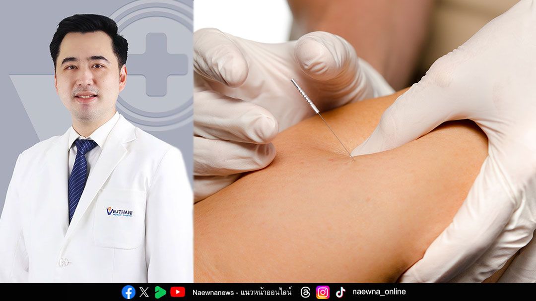 หยุดความปวดจากออฟฟิศซินโดรม ด้วยการฝังเข็ม Dry Needling