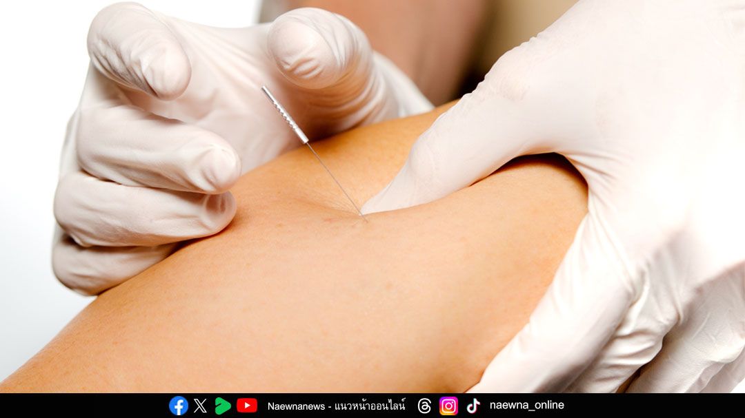 ฝังเข็ม Dry Needling หยุดความปวดจากออฟฟิศซินโดรม