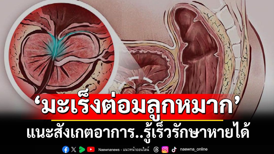 ‘แพทย์ชนบท’เตือนผู้ชายสังเกตอาการ ย้ำ‘มะเร็งต่อมลูกหมาก’ตรวจพบเร็วรักษาหายได้