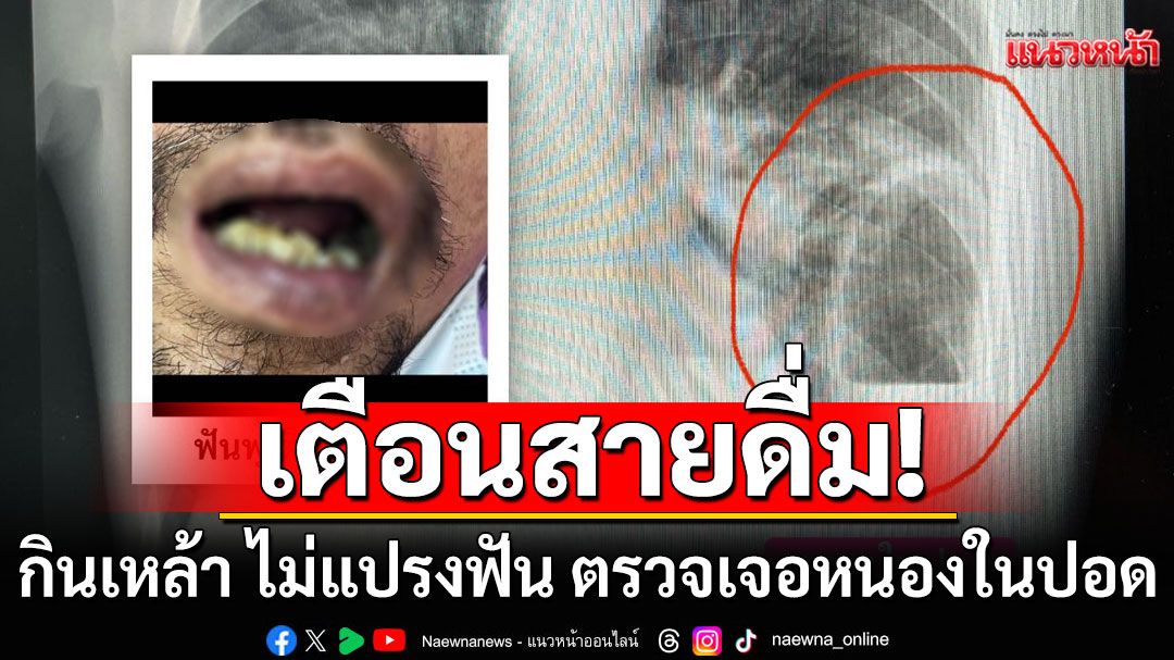 เตือนสายดื่ม! หมอเปิดเคส'กินเหล้า ไม่แปรงฟัน' ป่วยหายใจหอบ ฟันผุทุกซี่ ตรวจเจอฝีหนองในปอด