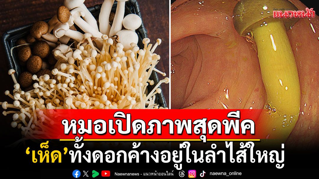 ชาวเน็ตอึ้ง! หมอแชร์ภาพสุดพีค'เห็ดทั้งดอก'ค้างในลำไส้ใหญ่ ตอกย้ำคนกินกับฉายา'เจอกันพรุ่งนี้'