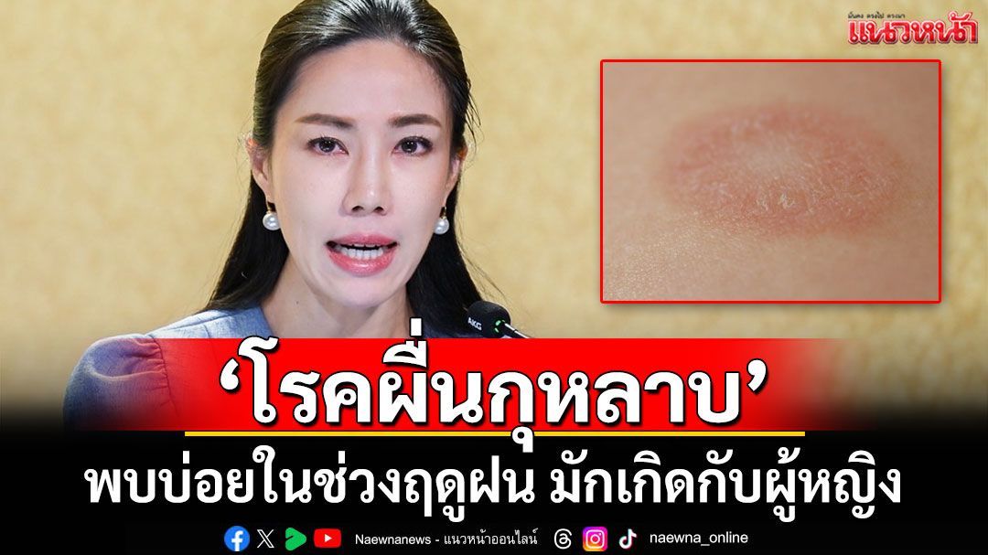 เตือน'โรคผื่นกุหลาบ' พบบ่อยในช่วงฤดูฝน มักเกิดกับผู้หญิง