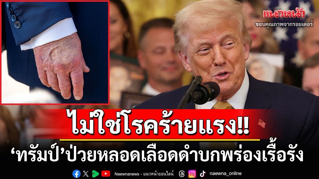 สยบข่าวลือป่วยหนัก! ทำเนียบขาวเผย‘ทรัมป์’มีภาวะหลอดเลือดดำบกพร่องเรื้อรัง ยันไม่ใช่โรคร้ายแรง