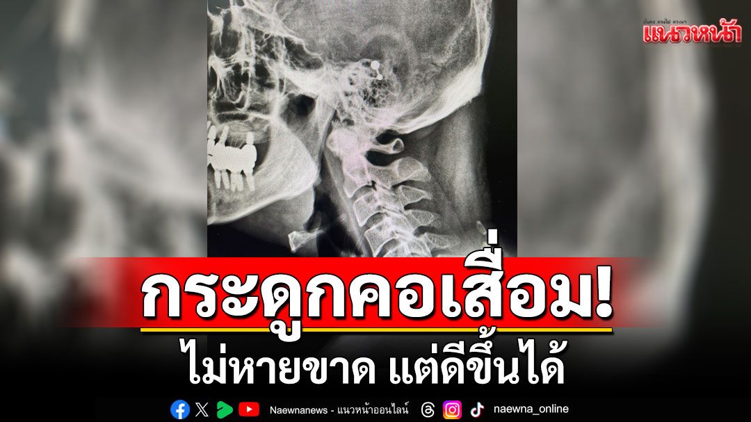 หมอชี้'กระดูกคอเสื่อม'ไม่หายขาด แต่ดีขึ้นได้ พร้อมแนะวิธีทำยังไง