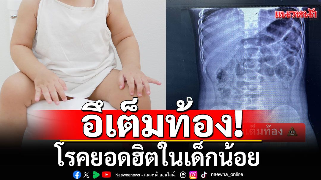 หมอยกเคส'อึเต็มท้อง' โรคยอดฮิตในเด็กน้อย พร้อมแนะวิธีแก้ไข