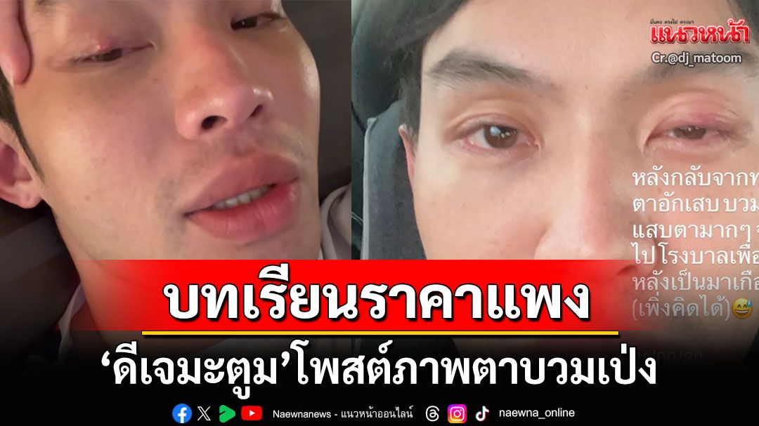 'ดีเจมะตูม'โพสต์ภาพตาบวมเป่ง ฝากบอกทุกคน'เรื่องตา'อย่าหาทำ