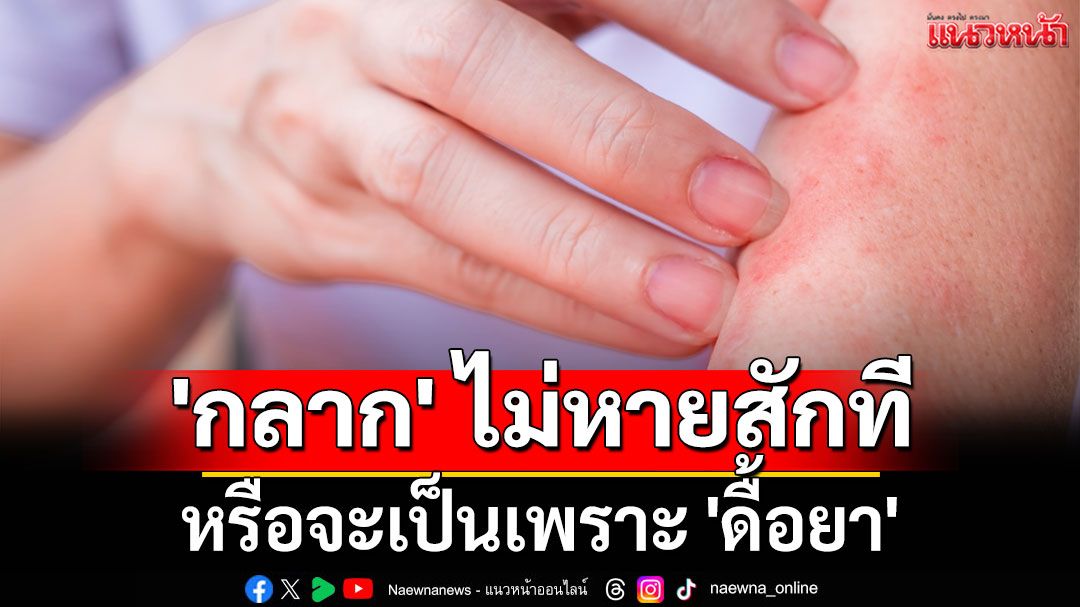 'กลาก' ไม่หายสักที หรือจะเป็นเพราะ 'ดื้อยา'