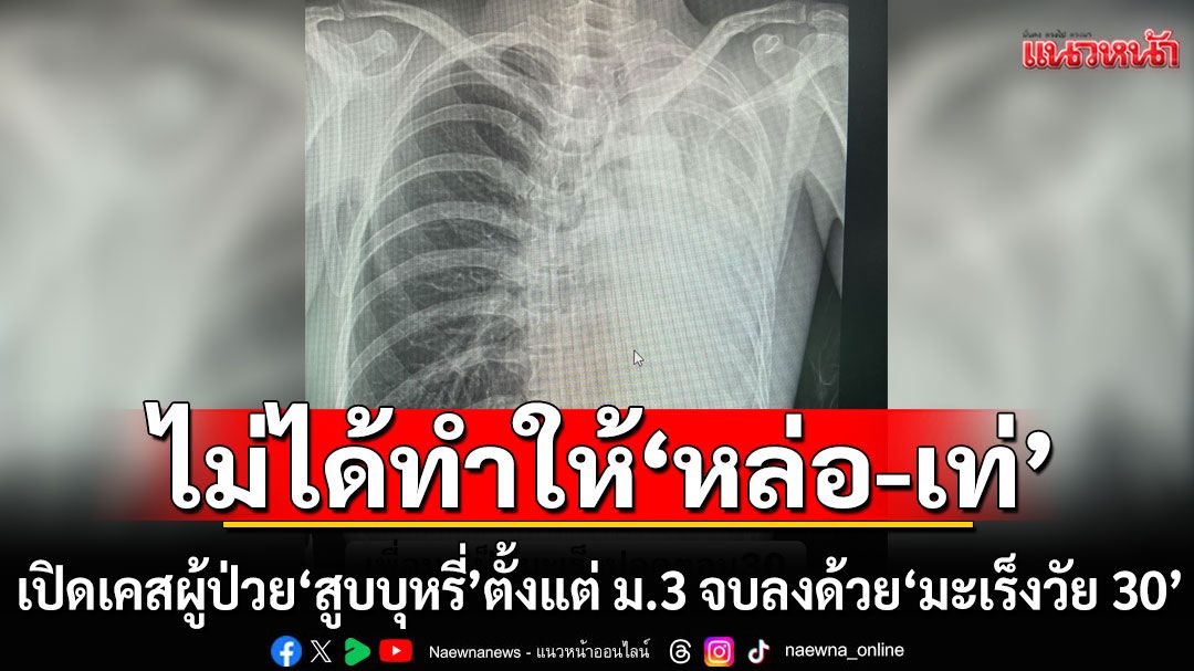 หยุดเถอะ!!! เปิดเคสผู้ป่วย'สูบบุหรี่' ตั้งแต่ ม.3 จบลงด้วย 'มะเร็งวัย 30' หมอย้ำไม่ทำให้หล่อ-เท่