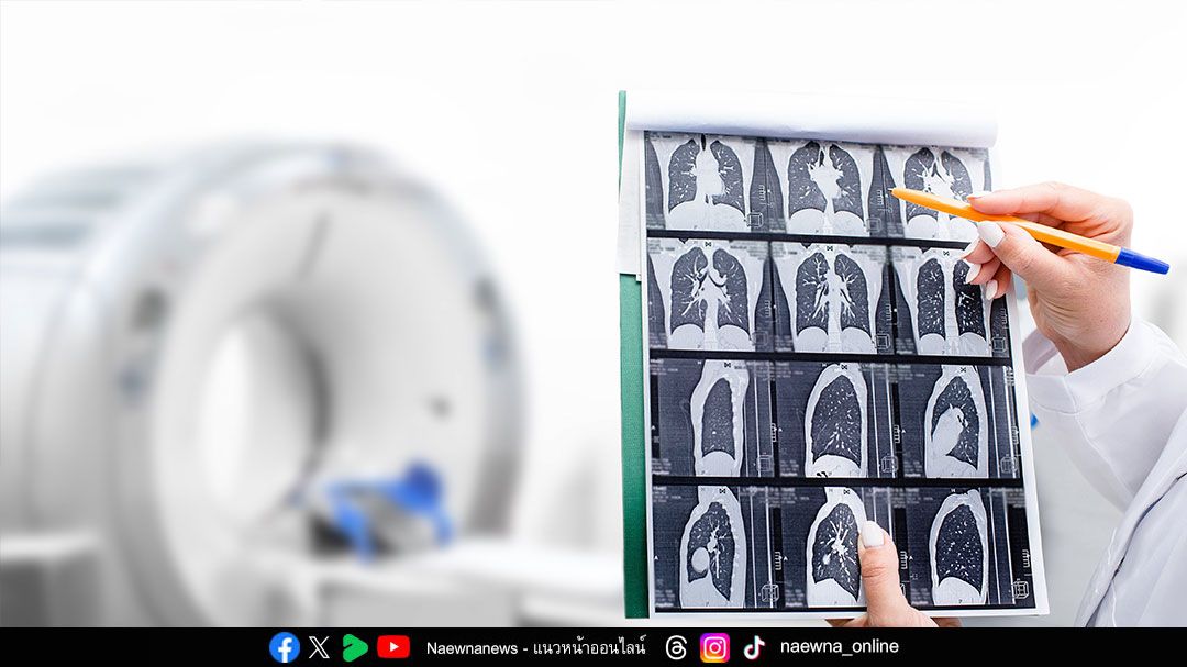 Health News : ผู้ป่วยมะเร็งปอด’ ถึง 1 ใน 5 ไม่สูบบุหรี่