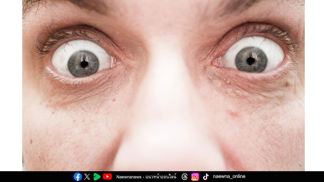 ตาโปน ตาแห้ง อย่ามองข้าม ‘ไทรอยด์ขึ้นตา’ โรคอันตรายของเบ้าตาที่ควรรู้