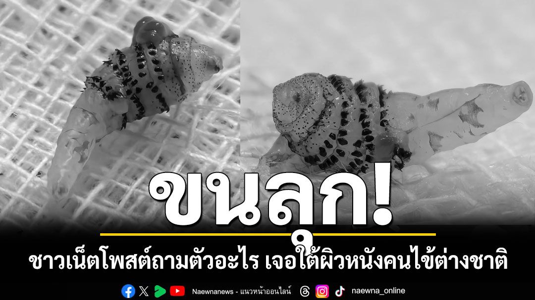 ขนลุก! ชาวเน็ตโพสต์ถามนี่ตัวอะไร เจอใต้ผิวหนังคนไข้ชาวต่างชาติ