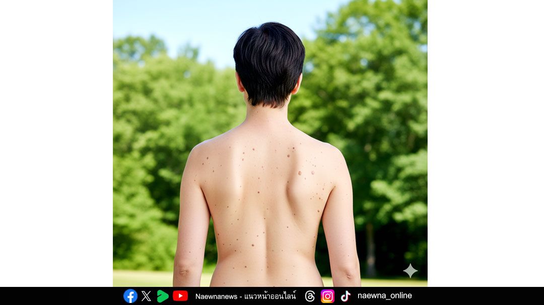 ไฝ ปาน จำนวนมาก อาจเสี่ยงมะเร็งผิวหนัง โรคใกล้ตัวที่ไม่ควรมองข้าม