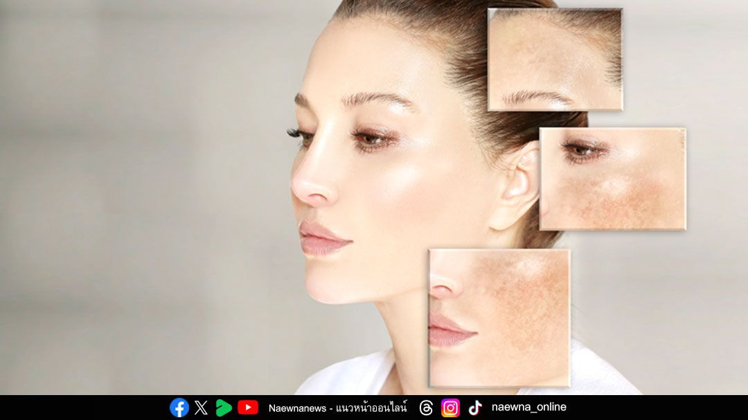 หน้าหนาว แดดแรง เสี่ยงฝ้าแดด ภัยเงียบจากแสงอาทิตย์