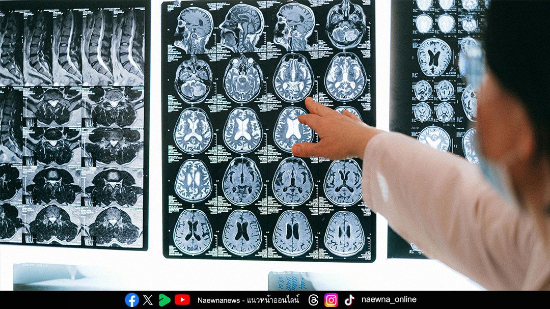 ‘สโตรกสมอง’ คร่าชีวิตคนไทยทุก 10 นาที รู้ทัน BEFAST ลดเสี่ยงพิการ-เสียชีวิต