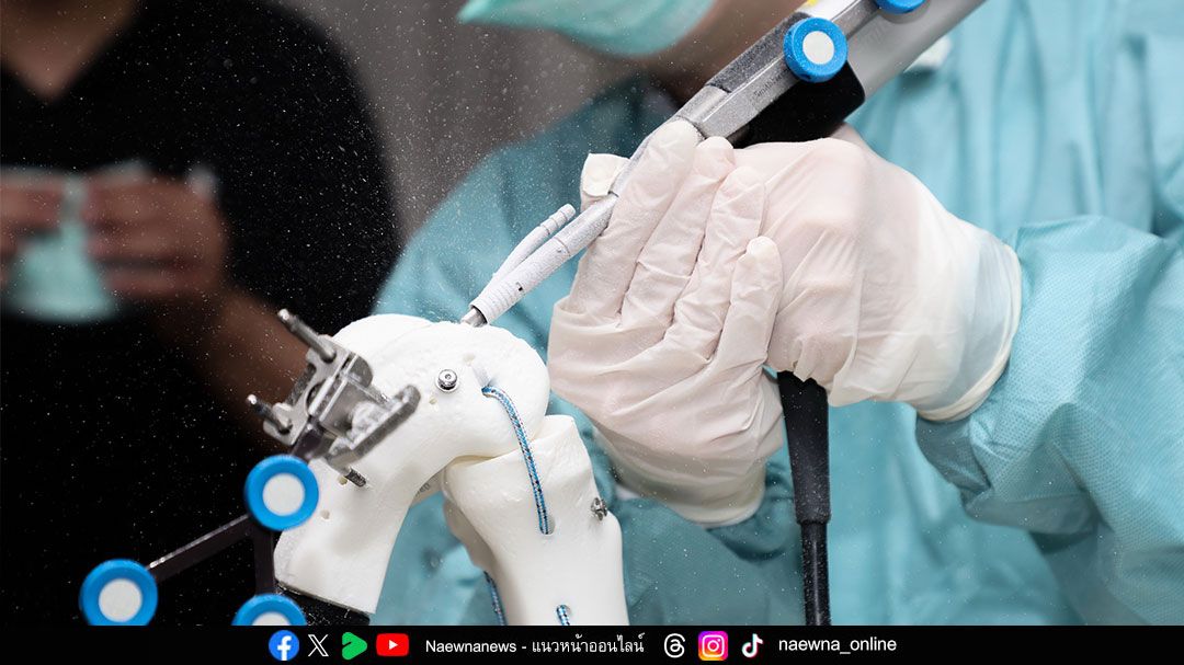พลิกเกมรักษาโรคข้อเข่าเสื่อม ด้วยหุ่นยนต์ผ่าตัดข้อเข่า เพิ่มความแม่นยำ เจ็บน้อย ฟื้นตัวเร็ว ทางเลือกใหม่ของผู้ป่วยไทย