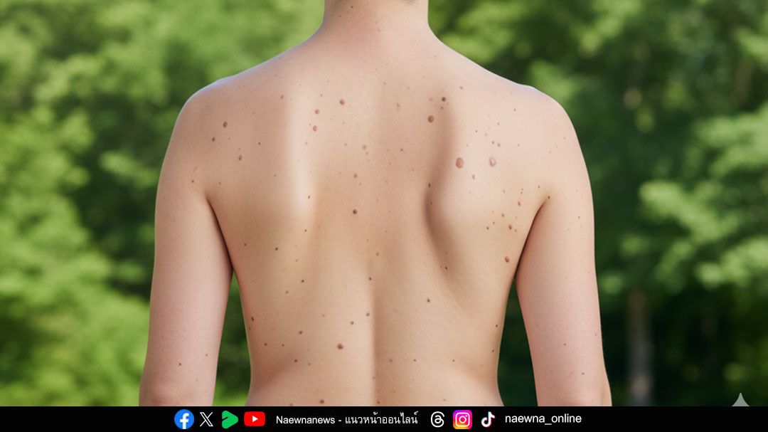 หน้าหนาว แต่แดดแรง ระวัง ‘มะเร็งผิวหนัง’ โรคใกล้ตัวที่ไม่ควรมองข้าม