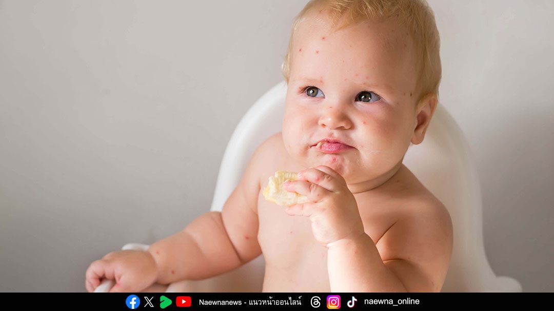 พ่อแม่ควรหมั่นสังเกตอาการ ‘ภูมิแพ้อาหาร’ ในเด็ก
