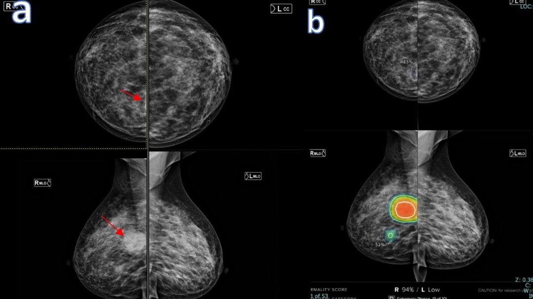 Health News : AI ช่วยพบความเสี่ยงมะเร็งเต้านม