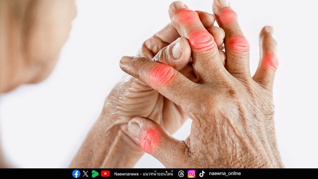 ‘รูมาตอยด์’ โรคข้ออักเสบจากความผิดปกติของระบบภูมิคุ้มกัน