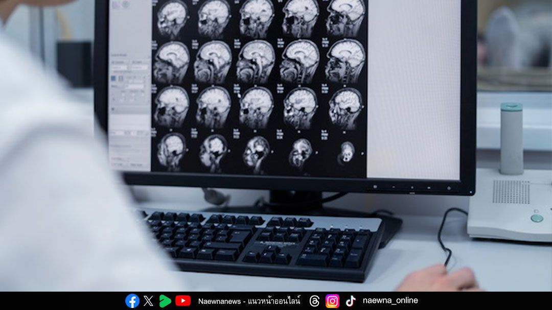 ‘1 นาที สูญเสีย 1 ล้านเซลล์สมอง’ ภัยร้าย ‘สโตรก’ เกิดขึ้นได้กับทุกคนแม้สุขภาพแข็งแรง วัยทำงานเสี่ยงพุ่ง